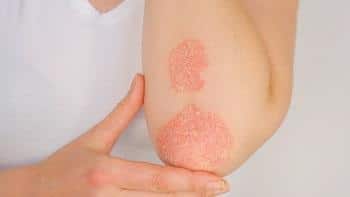 dealing with psoriasis 633c1e9ab6b4e