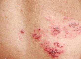 finding the right treatment for shingles 633c1db6602b0