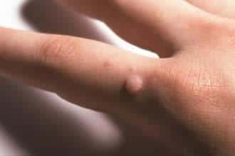 finding the right treatment for warts on your hands 633c1dfd5423e