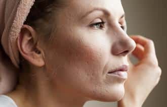 healing your acne scars 633c1e41c0c7f