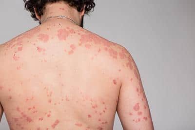 how to deal with your psoriasis symptoms 633c1d69eb84b