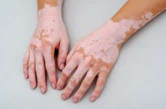 treating your vitiligo 633c1d9fa200a