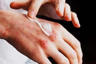 understanding and treating eczema 633c1e1f2c6b2