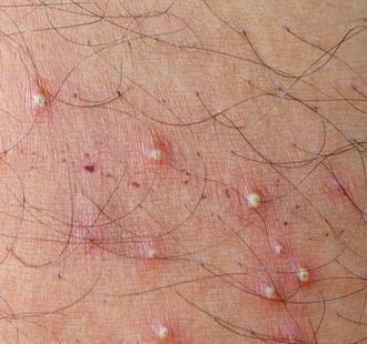 what are hair follicle infections 633c1dc3c1eef