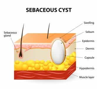 what are sebaceous cysts 633c1dc82d507