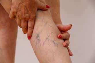what are spider veins 633c1d9683738