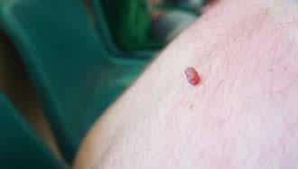 what is a skin tag 633c1df873d7b