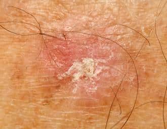 what is actinic keratosis 633c1dad47db9
