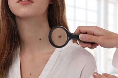 when to get your mole checked 633c1d567821d
